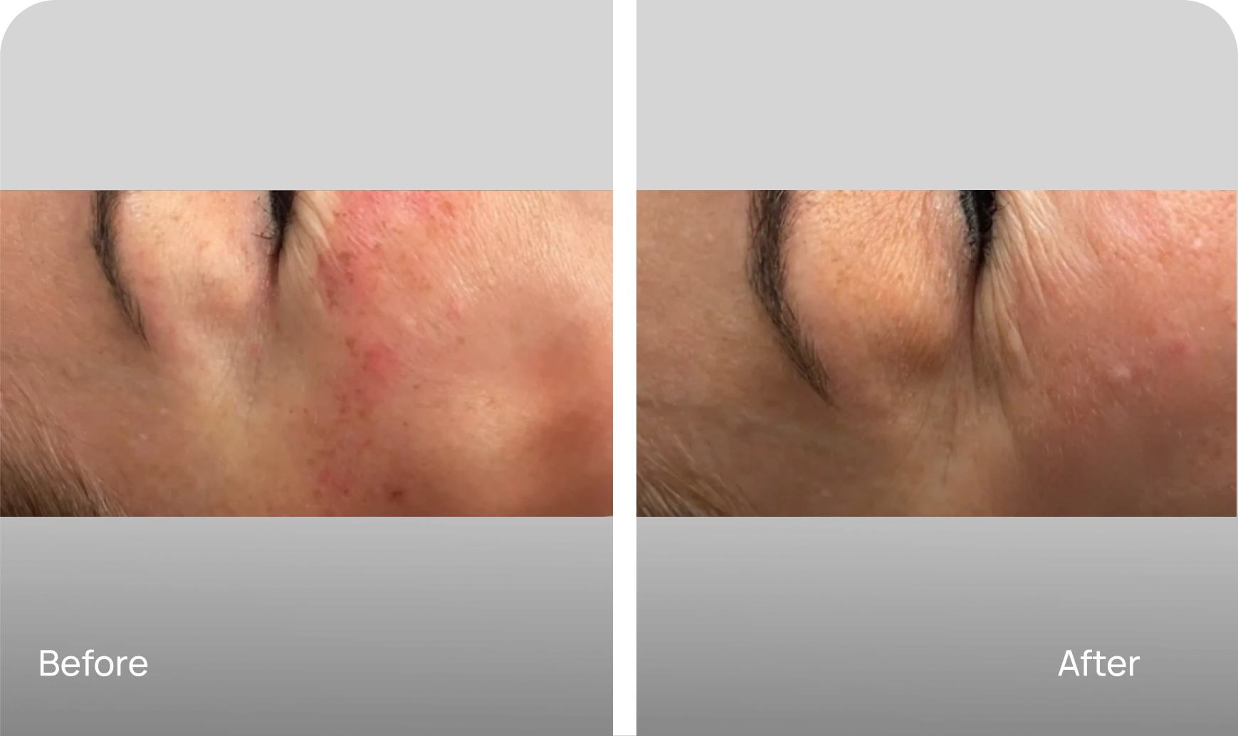 Hipperpigmentation Treatment - Case 1