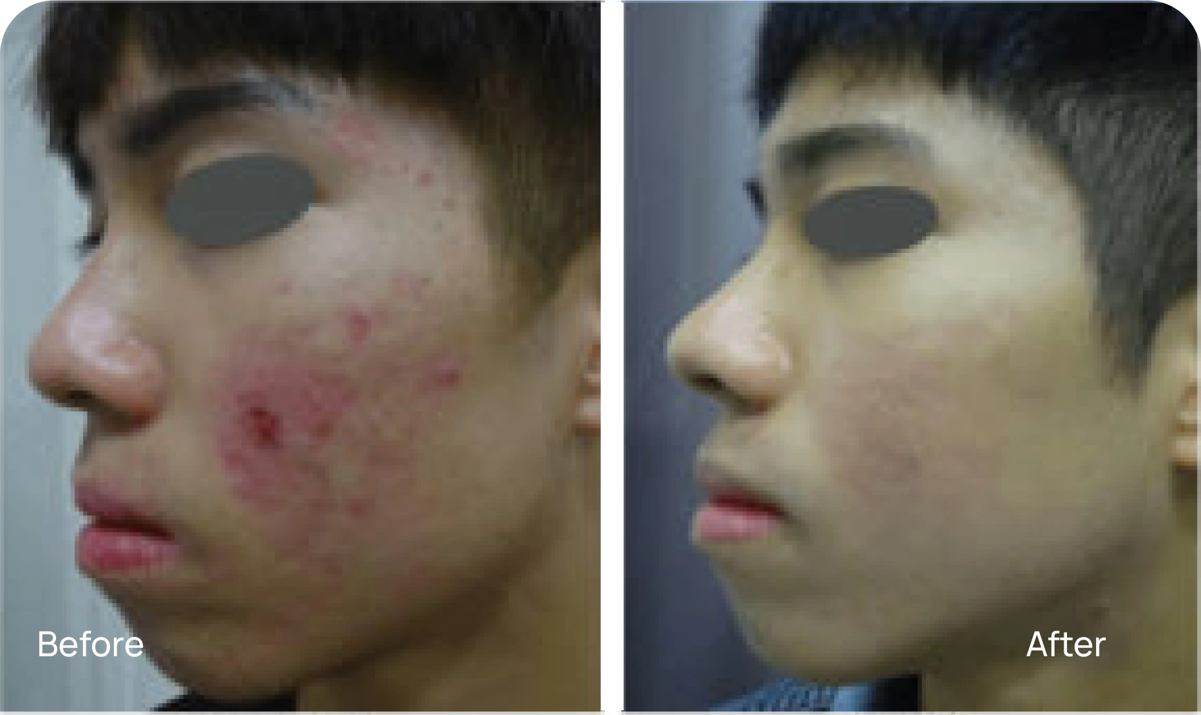 RF Microneedling - Case 1