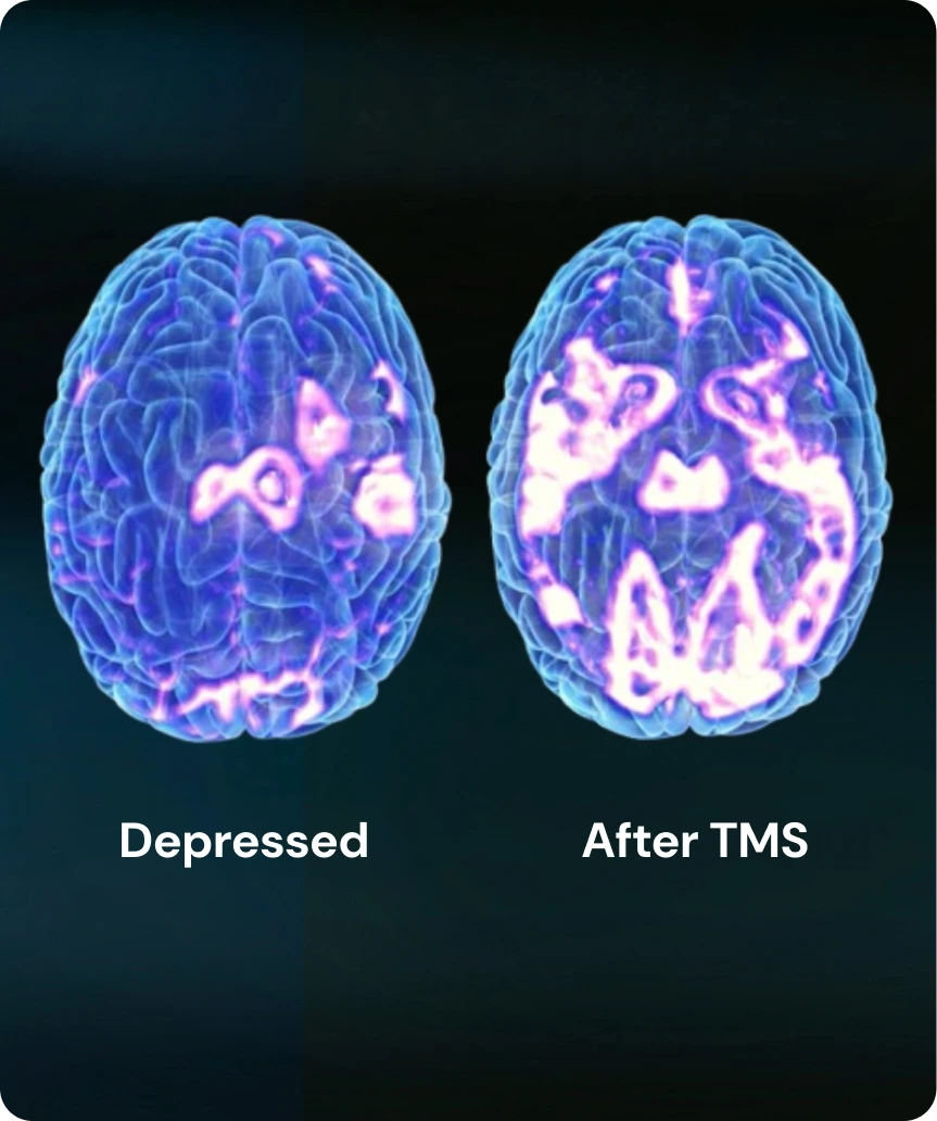 TMS Therapy Step by Step Procedure Banner