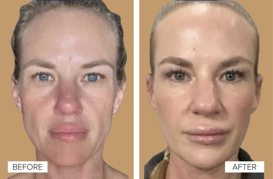Before and After Gallery: EMFACE