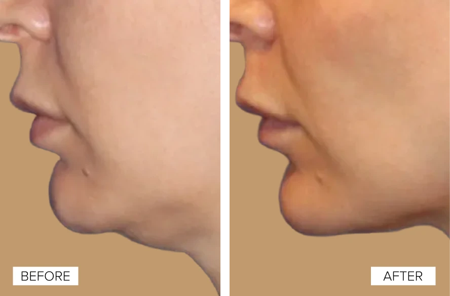 Before and After Gallery: EMFACE