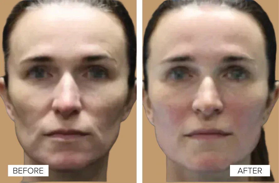 Before and After Gallery: EMFACE