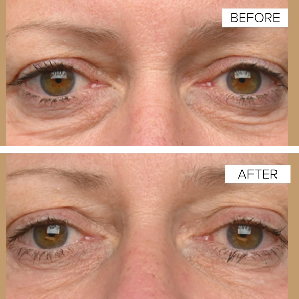 Before and After Gallery: EMFACE