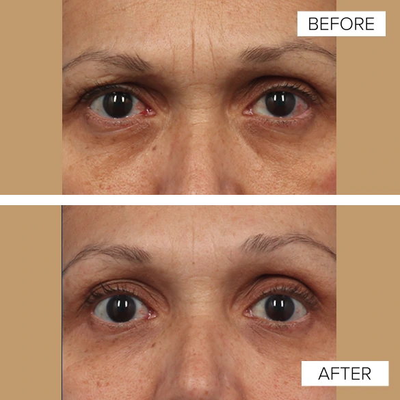 Before and After Gallery: EMFACE