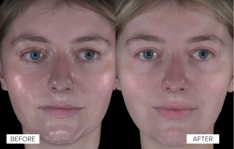 Before and After Gallery: Sofwave