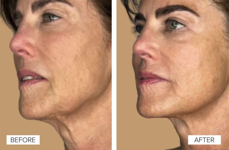 Before and After Gallery: Sofwave