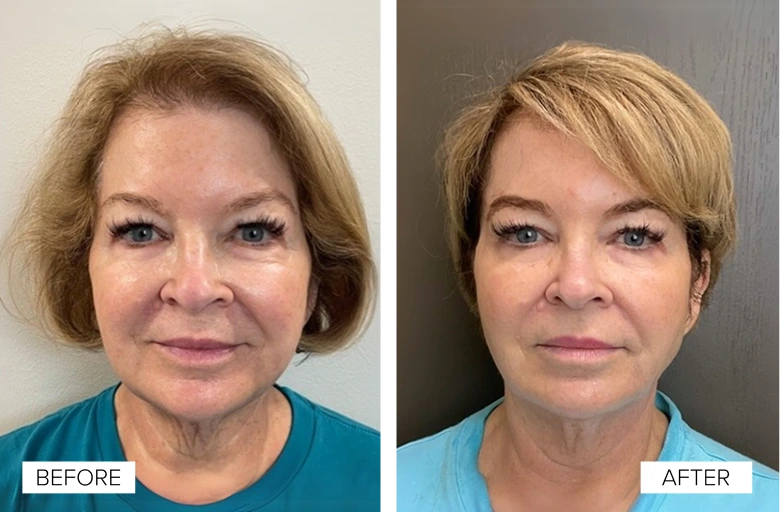 Before and After Gallery: Sofwave