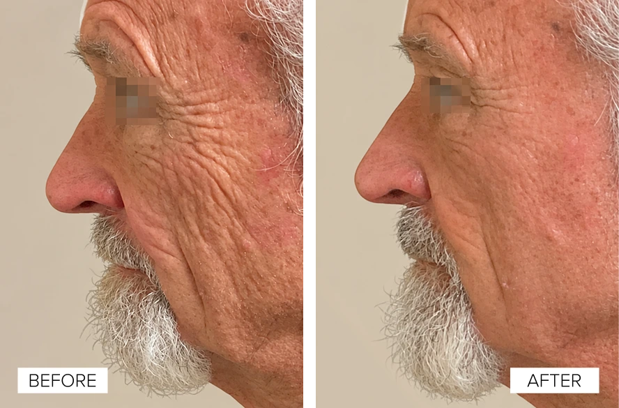 Before and after side profile showing reduced facial wrinkles and improved skin texture