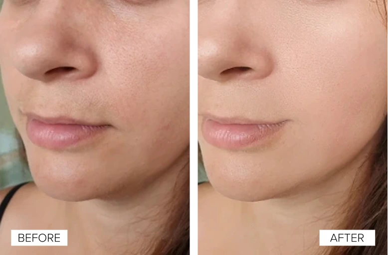 Before and after Sofwave treatment showing reduced skin texture and improved jawline definition