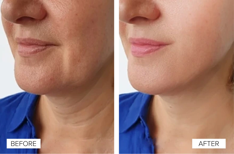 Before and after comparison showing improved lip fullness and definition from Sofwave treatment