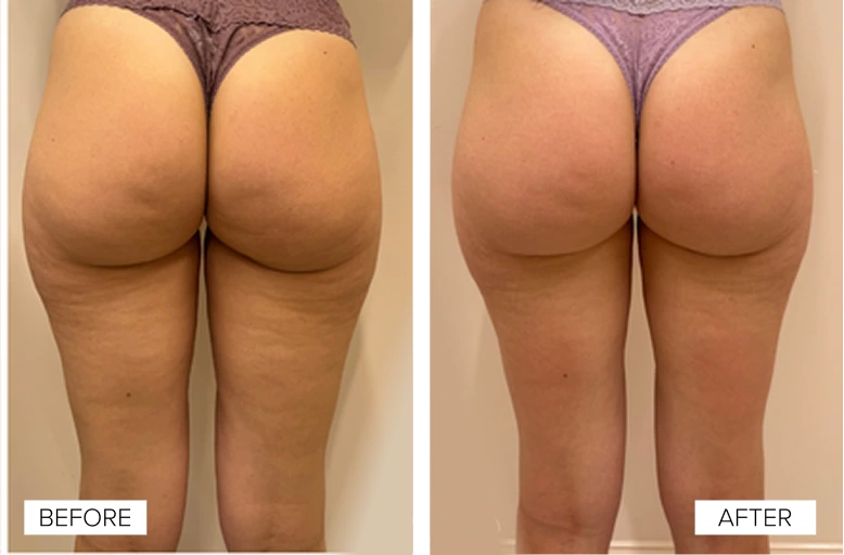 Before and after comparison of cellulite reduction on legs and buttocks following Sofwave treatment