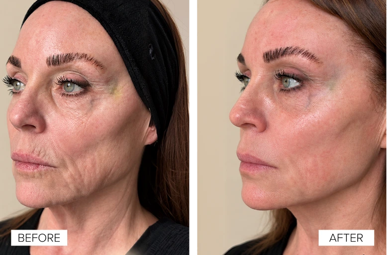 Before and after profile comparison showing facial skin texture improvement with reduced fine lines and wrinkles