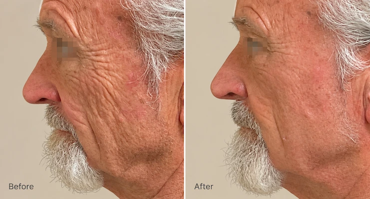 Before and after profile view of male patient showing reduced facial wrinkles and improved skin texture from XERF treatment