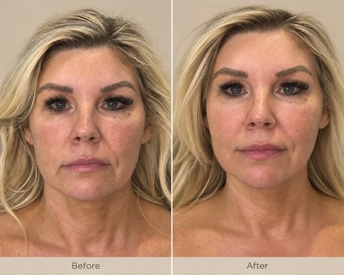 Before and after XERF treatment showing reduced wrinkles and improved skin texture on a patient's face