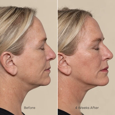 Before and after profile view of XERF Case 3 showing facial rejuvenation results at 4 weeks