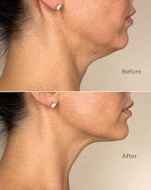 Before photo: side profile of person's jawline and neck showing skin laxity