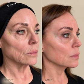 Before and after profile views of a woman's face showing skin texture improvement from Softwave treatment