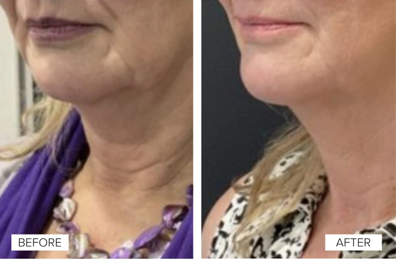 Before and After Gallery: Sofwave