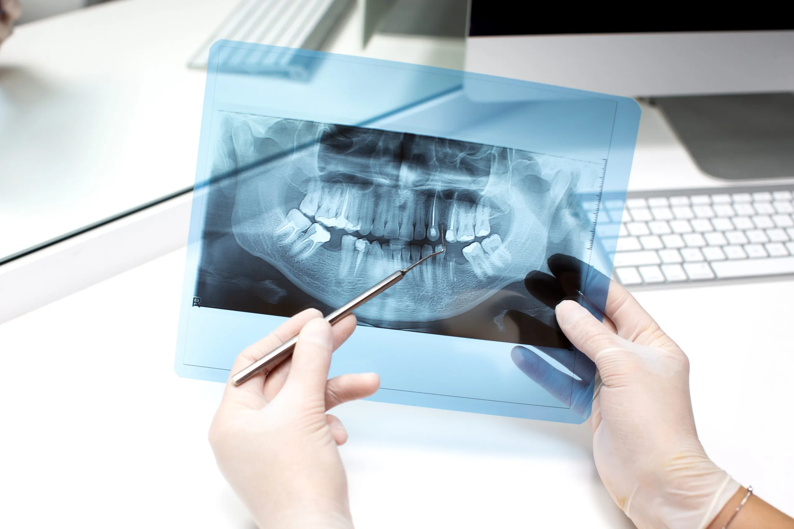 How Long Do Root Canals Last? Factors That Can Affect Banner