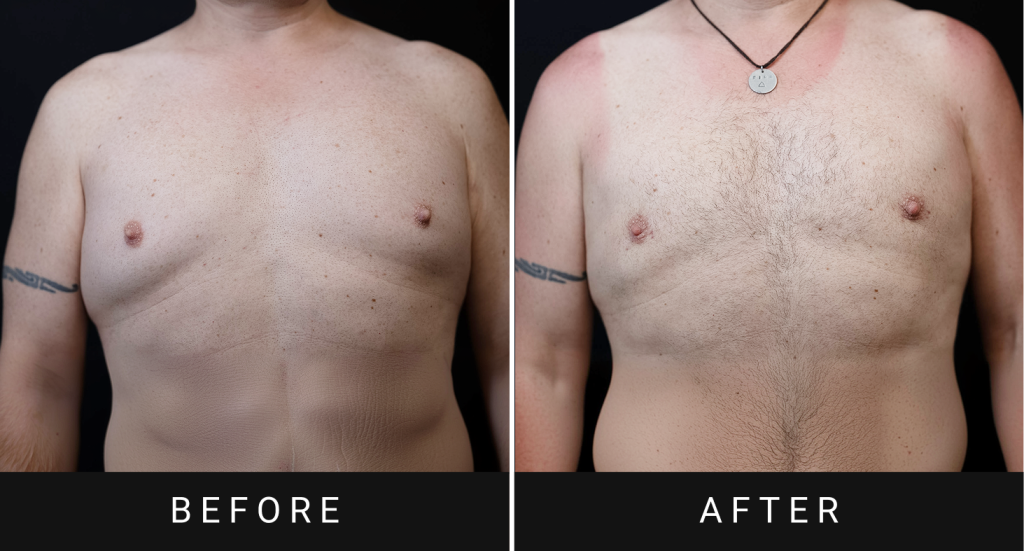 Before and after gynecomastia treatment showing male chest reduction results