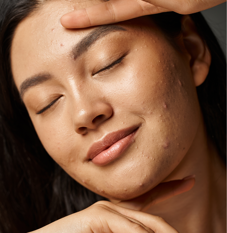 Person's face showing acne and blemishes on forehead and cheek, eyes closed
