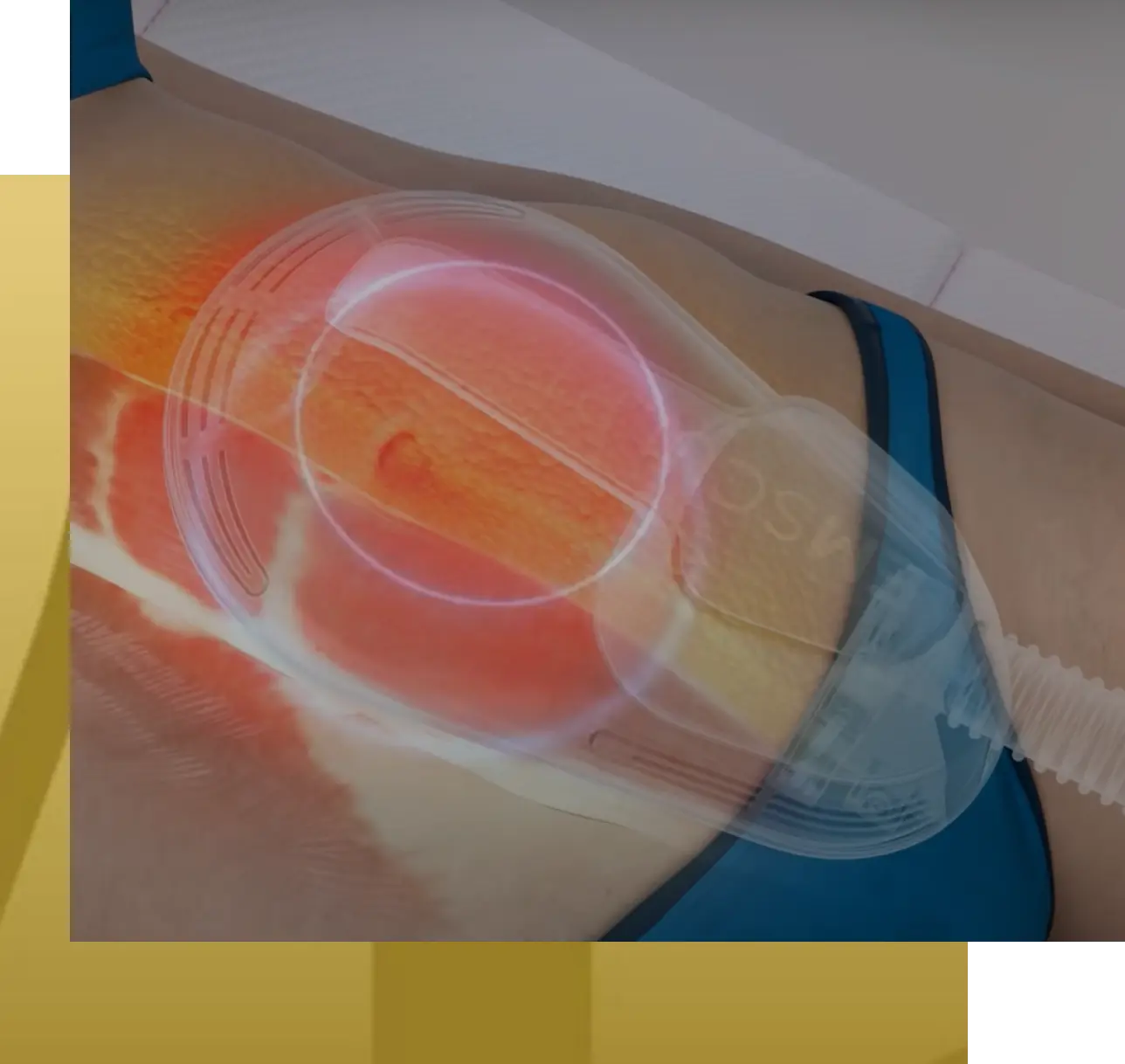 EmSculpt Experience Banner