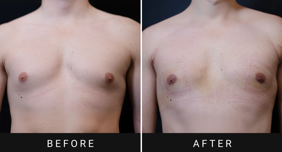 Before and after gynecomastia treatment showing reduced breast tissue