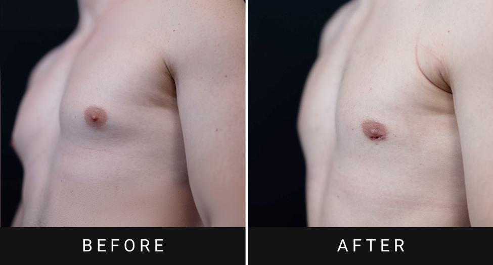 Before and after gynecomastia treatment showing reduced breast tissue and improved chest contour