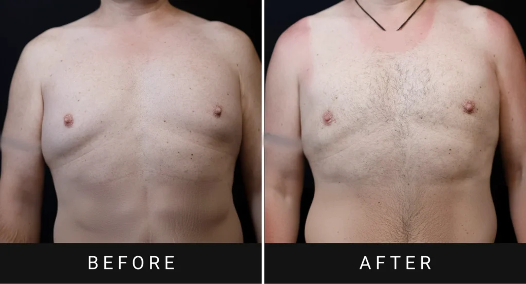 Before and after gynecomastia treatment showing male chest reduction results