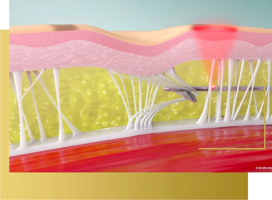 What is Avéli? Banner