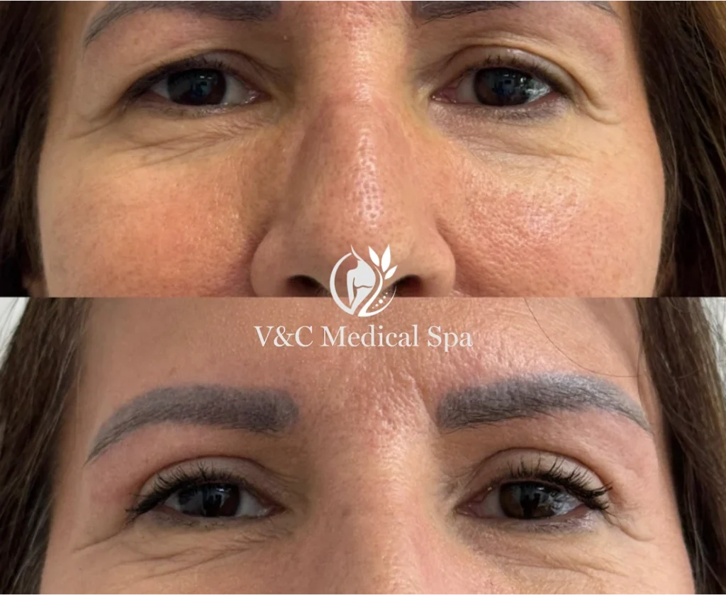CO2 Laser Blepharoplasty results gallery Banner
