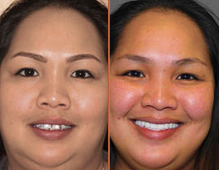 Before and after cosmetic dental treatment showing patient's brighter, whiter smile