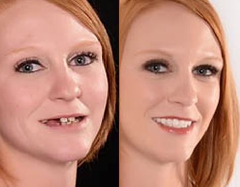 Before and after smile transformation showing improved tooth alignment and appearance