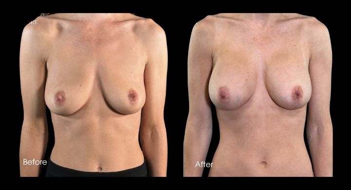 breast-augmentation-case-2-1