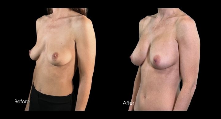 breast-augmentation-case-2-2