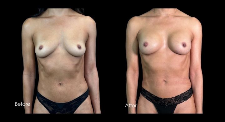 breast-augmentation-case-3-2