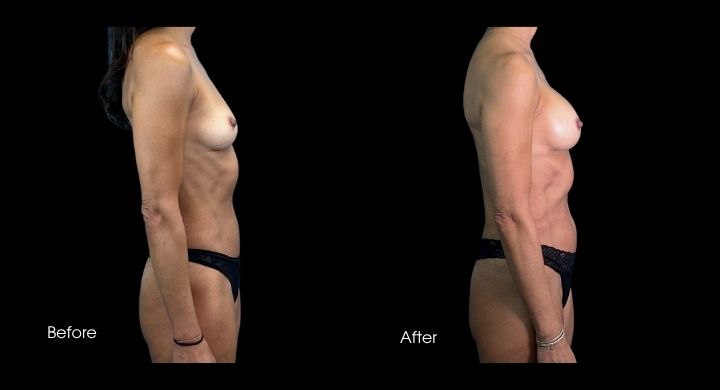 breast-augmentation-case-3-3
