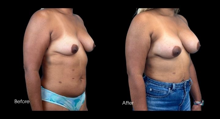 breast-augmentation-case-4-2