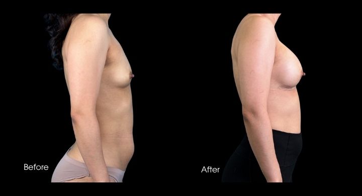 breast-augmentation-case-5-2