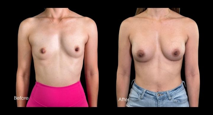 breast-augmentation-case-6-1