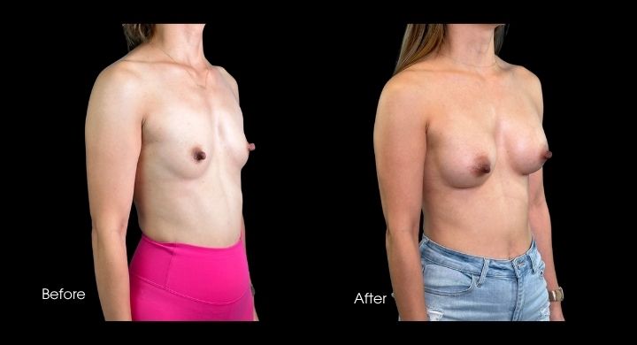breast-augmentation-case-6-2