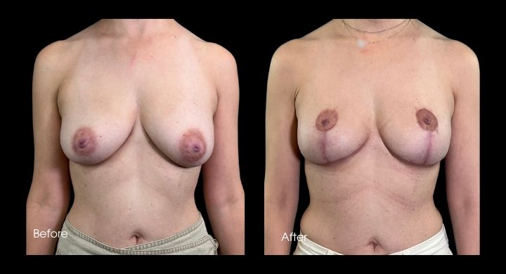 breast-lift-case-3-1