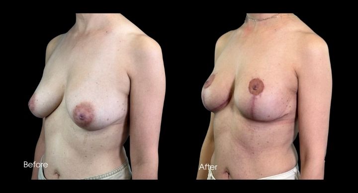 breast-lift-case-3-2