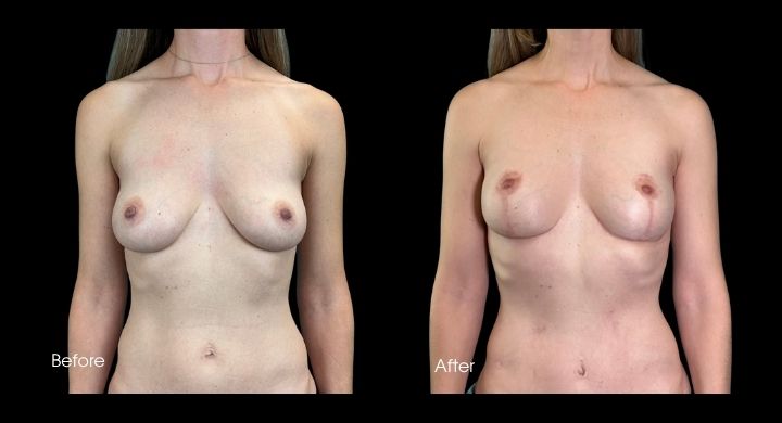breast-lift-case-4-1