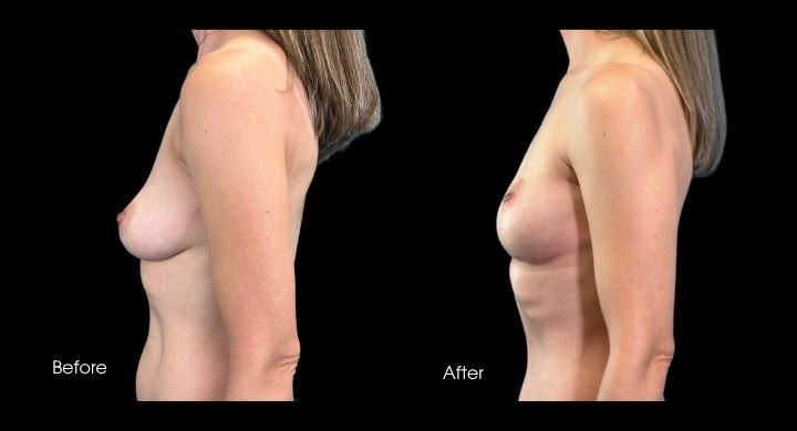 breast-lift-case-4-2