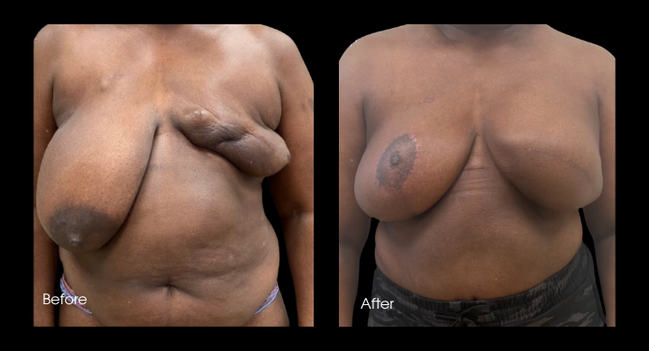 Breast Reconstruction - Delayed (1)