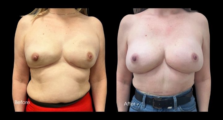 Breast Reconstruction - DIEP Flap (2)