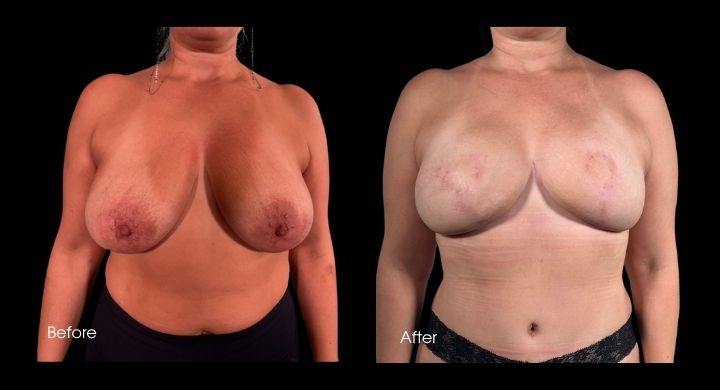 Breast Reconstruction - DIEP Flap (3)