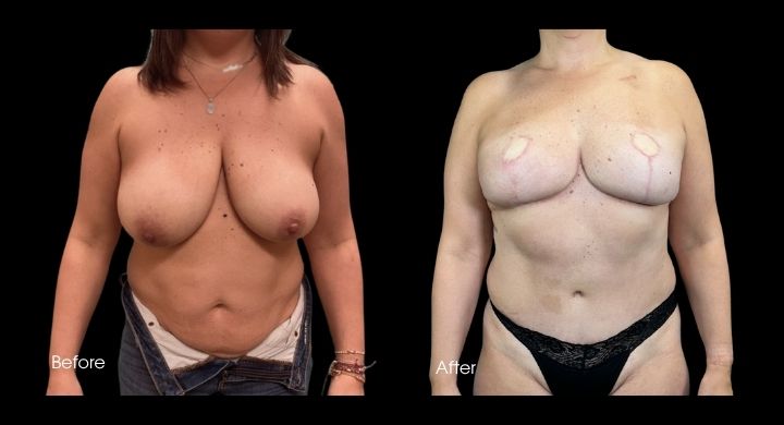 Breast Reconstruction - DIEP Flap (4)