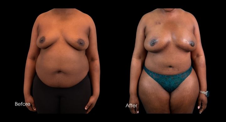 breast-reconstruction-diep-flap-case-1-1